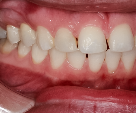 After Tooth #5 Implant