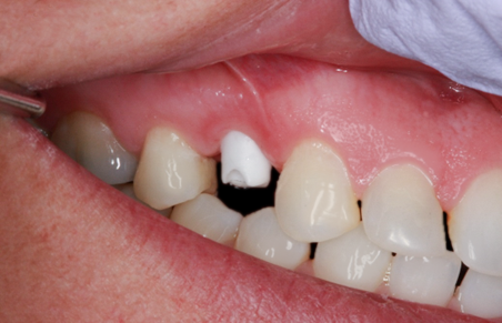 Before Tooth #5 Implant