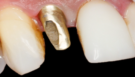 Before Tooth #7 Implant with Gold Abutment