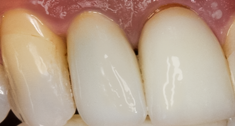 After Tooth #7 Implant with Gold Abutment