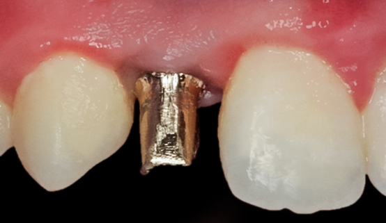 Before Tooth #7 Implant with Gold Abutment