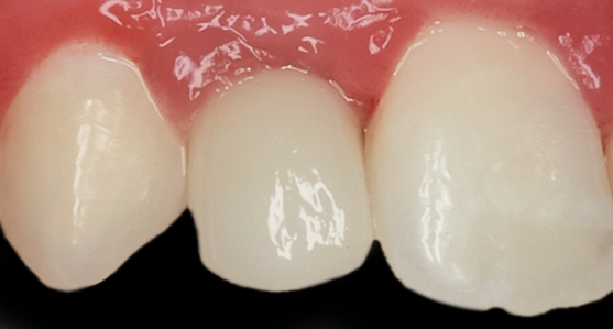 After Tooth #7 Implant with Gold Abutment