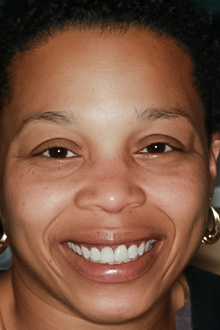 After Tooth #9 Implant & Crown