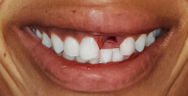Before detail, Tooth #9 Implant & Crown