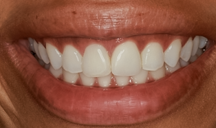 After detail, Tooth #9 Implant & Crown