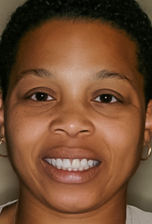 Before Tooth #9 Implant & Crown