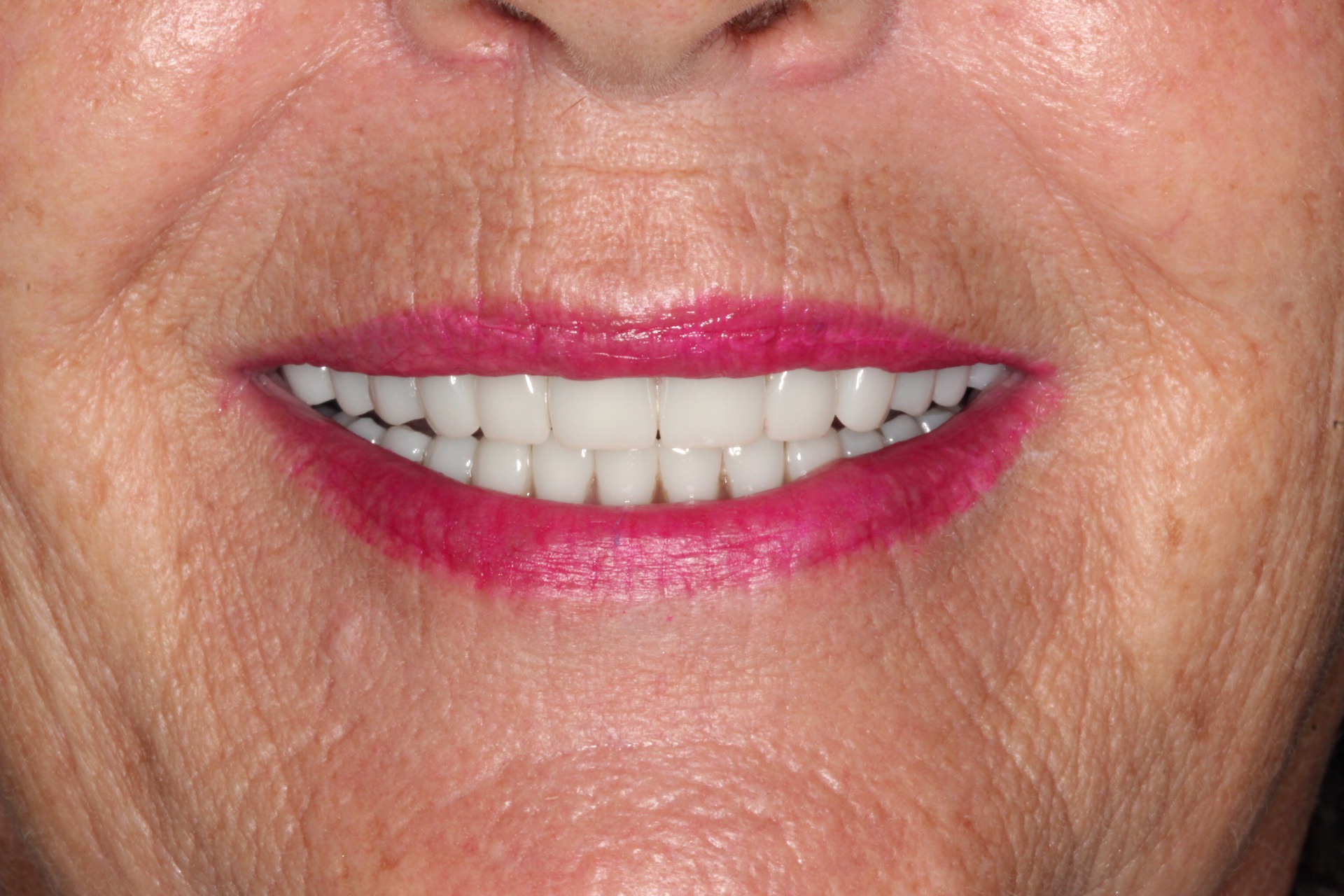 After Tracey's Full-Mouth Smile Makeover