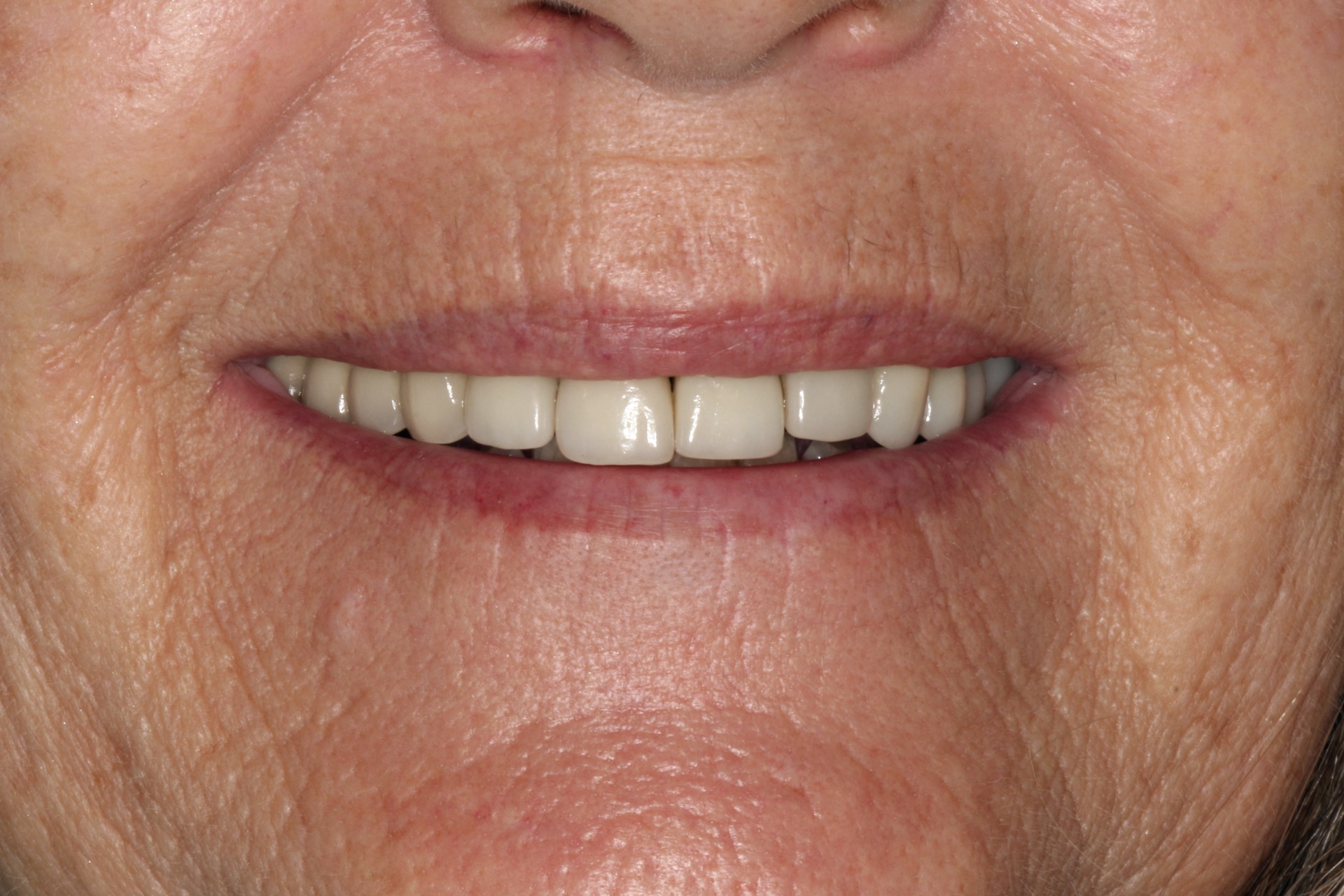 Before Tracey's Full-Mouth Smile Makeover