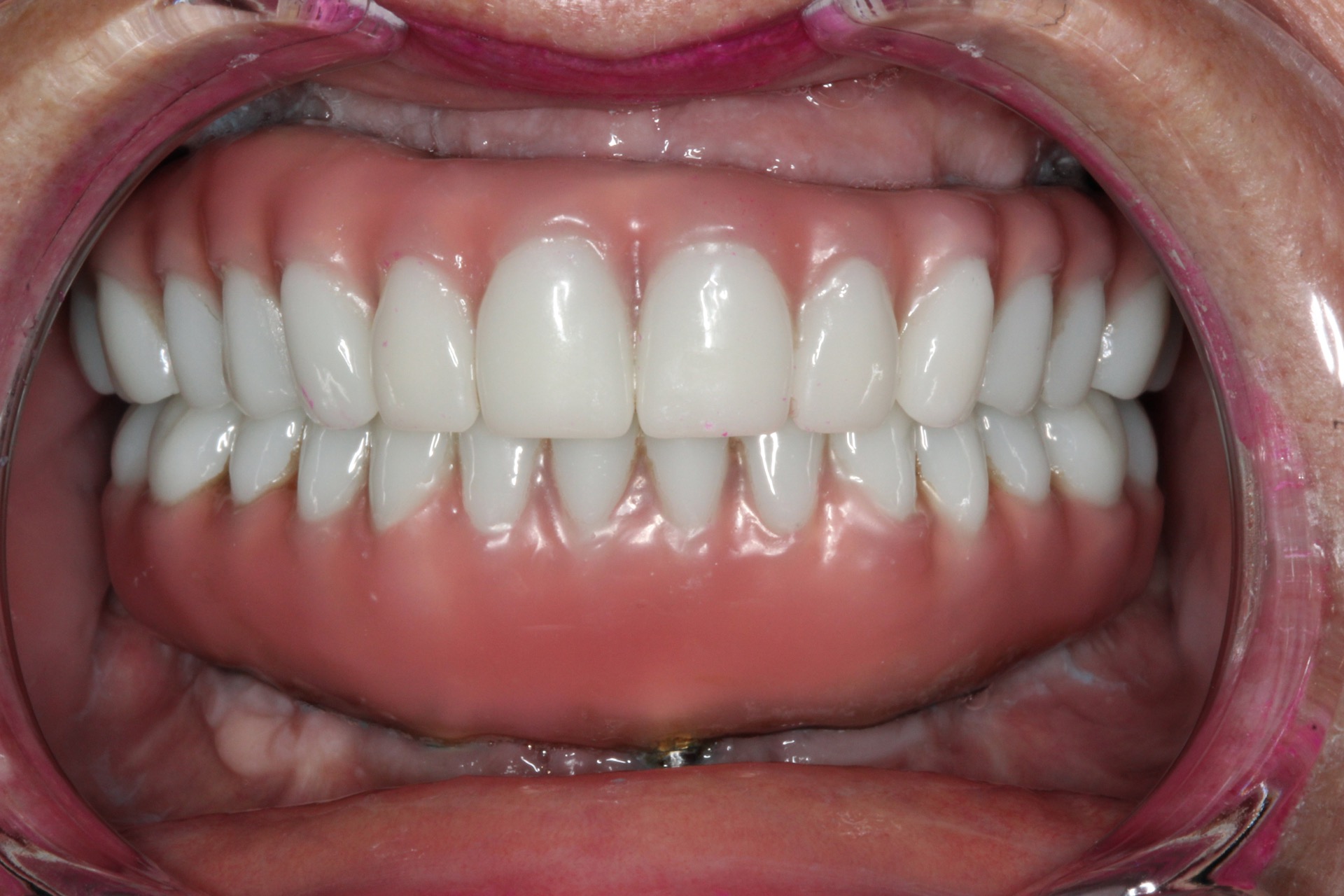 Tracey after retracted smile view