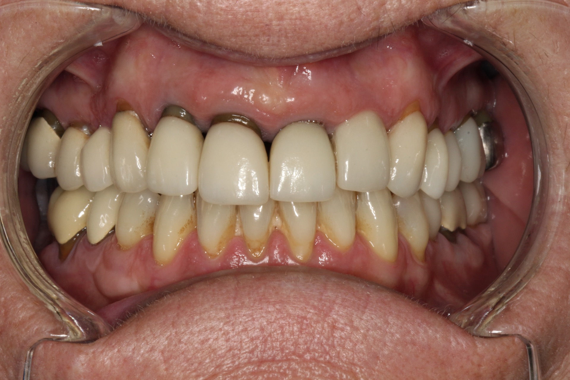 Tracey before retracted smile view