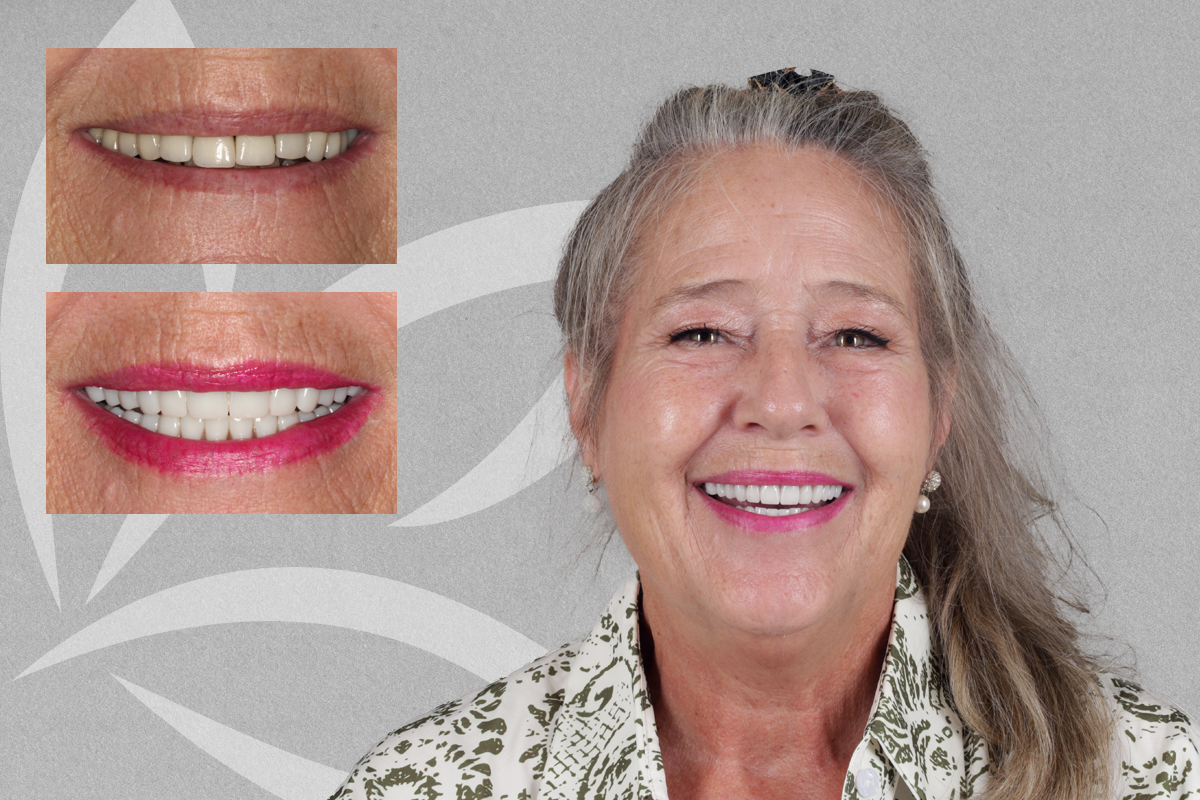 Tracey's Full-Mouth Smile Makeover featured transformation