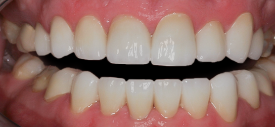 After Twenty Veneers & Crowns for Crooked Teeth