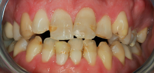 Before Twenty Veneers & Crowns for Crooked Teeth