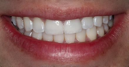 After Two Anterior Veneers, for Broken Teeth