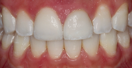 After detail, Two Anterior Veneers, for Broken Teeth