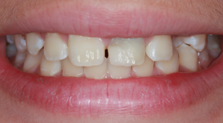 Before Two Anterior Veneers, for Broken Teeth