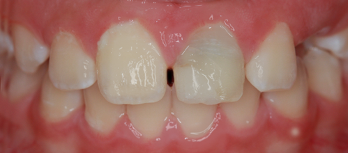 Before detail, Two Anterior Veneers, for Broken Teeth