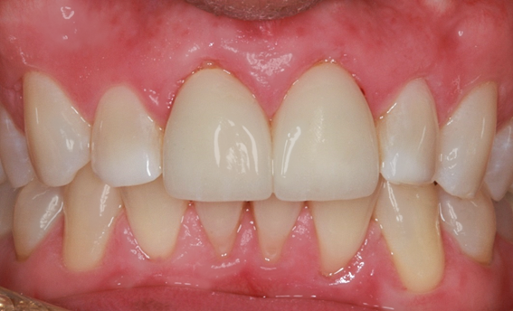 After Two Central Veneers