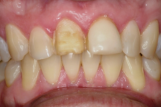 Before Two Central Veneers