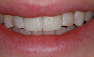 After detail, Two Central Veneers - To Treat Two Chipped Front Teeth