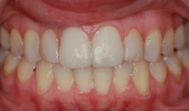After Two Central Veneers - To Treat Two Chipped Front Teeth