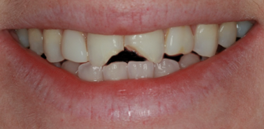 Before detail, Two Central Veneers - To Treat Two Chipped Front Teeth