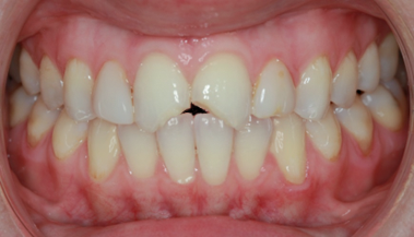 Before Two Central Veneers - To Treat Two Chipped Front Teeth