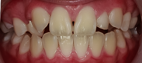 Before Two Implant Crowns to Replace Two Congenitally Missing Teeth