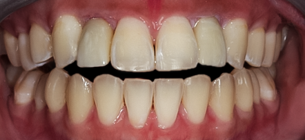 After Two Implant Crowns to Replace Two Congenitally Missing Teeth