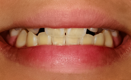 Before detail, Two Implant Crowns to Replace Two Congenitally Missing Teeth