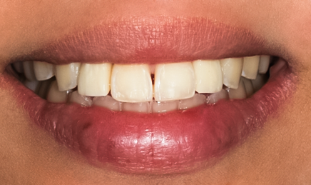 After detail, Two Implant Crowns to Replace Two Congenitally Missing Teeth