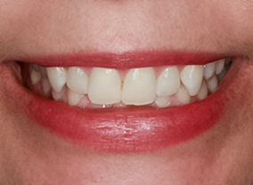 Before Two Lateral Incisor Veneers No-prep