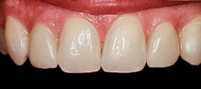 PowerPoint case photo, Two Lateral Incisor Veneers No-prep