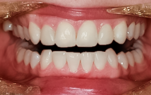 After detail, Two Lateral Incisor Veneers No-prep