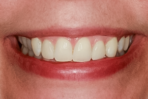 After Two Lateral Incisor Veneers No-prep