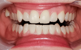 Before detail, Two Lateral Incisor Veneers No-prep