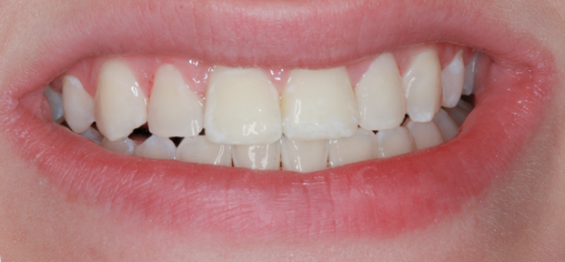Before Two Upper Veneers