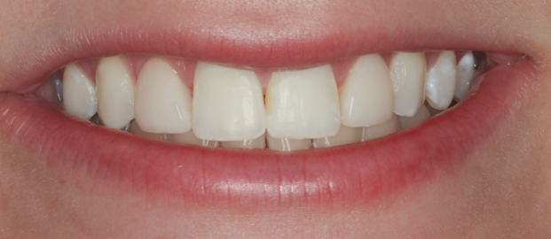 After Two Upper Veneers