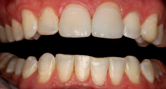 After Two Veneers & Crown, Kevin