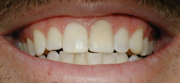 Before Two Veneers & Crown, Kevin