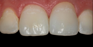 PowerPoint case photo, Two Veneers & Crown, Kevin