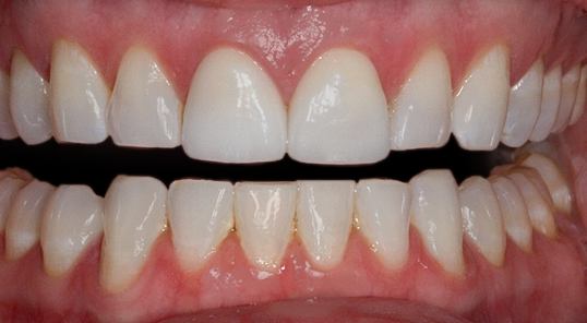 After Two Veneers, to Gain Symmetry