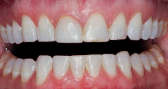 Before Two Veneers, to Gain Symmetry