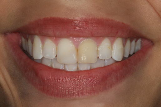Before Two Veneers, to Replace Old Bonding