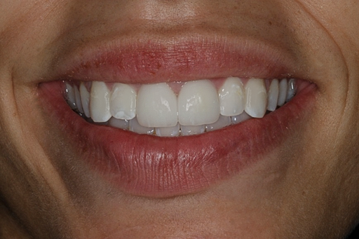 After Two Veneers, to Replace Old Bonding