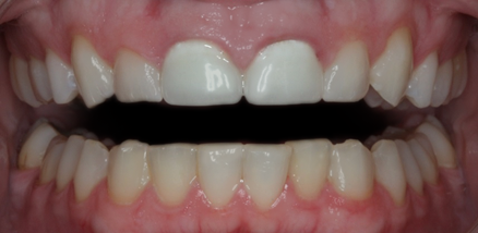 Before Two Veneers & Two Crowns, to Replace Two Short Front Crowns