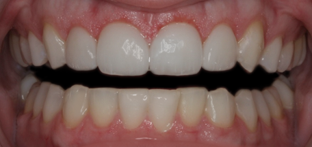 After Two Veneers & Two Crowns, to Replace Two Short Front Crowns