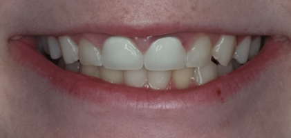 Before detail, Two Veneers & Two Crowns, to Replace Two Short Front Crowns