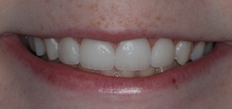 After detail, Two Veneers & Two Crowns, to Replace Two Short Front Crowns