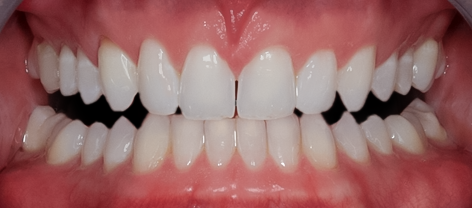 After Invisalign®, Wes